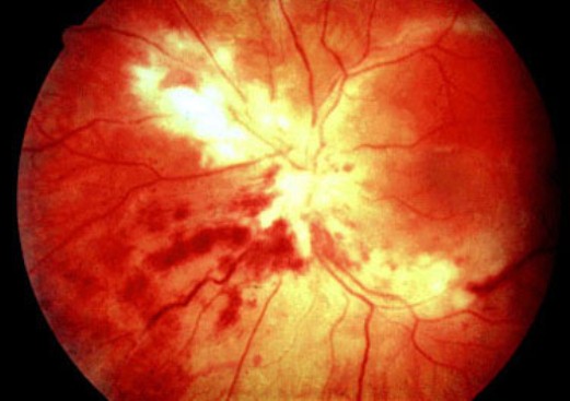 Цитомегаловирусный ретинит.