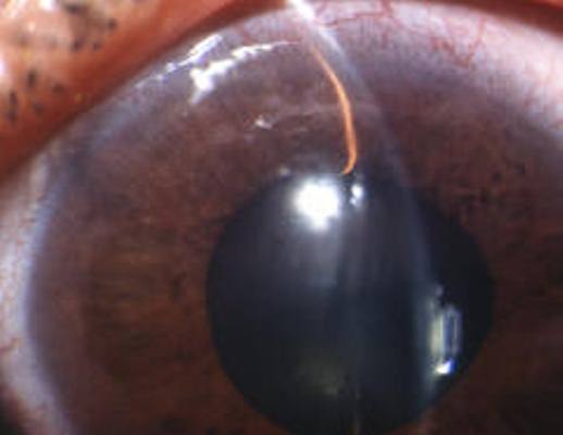 Глаукома смешанного угла передней камеры