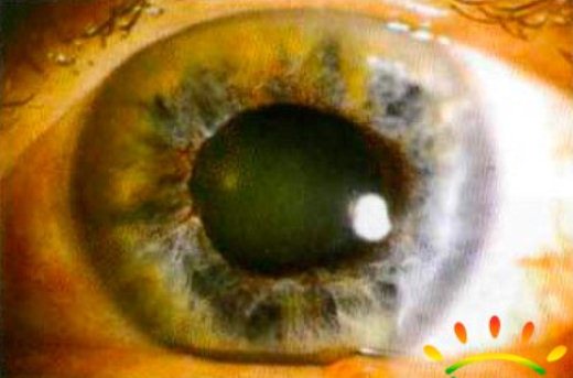 Первичная закрытая глаукома