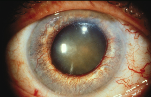 Поствоспалительная закрытоугольная глаукома.