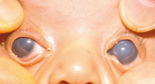 Первичная врождённая глаукома
