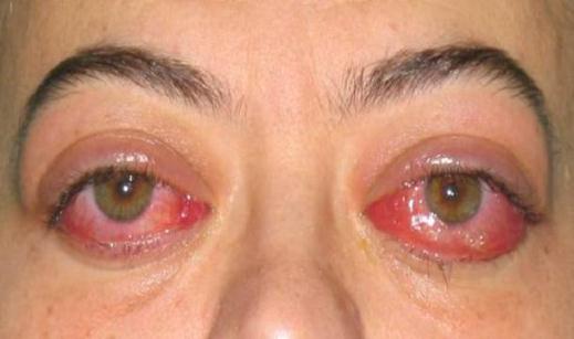 Тиреоидная болезнь глаза