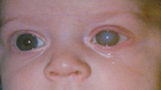 Детская катаракта.