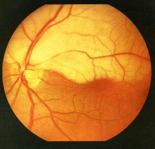 Окклюзия ретинальных артерий.