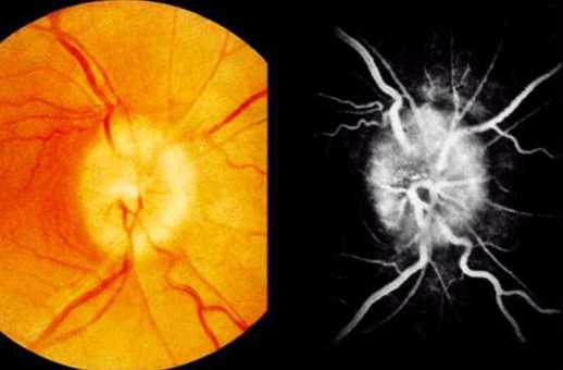 Гипертоническая ретинопатия.