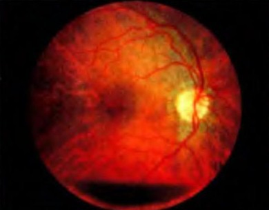 Серповидно-клеточная ретинопатия.