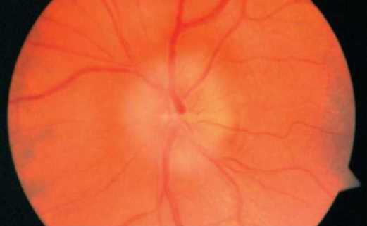 Передняя ишемическая оптическая нейропатия